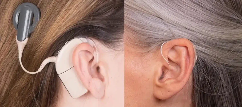 Hearing Aids vs Cochlear Implants