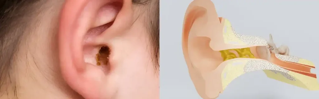 What is Earwax and Why Does It Affect Hearing Aids